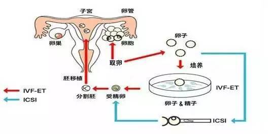 贵阳试管婴儿取卵